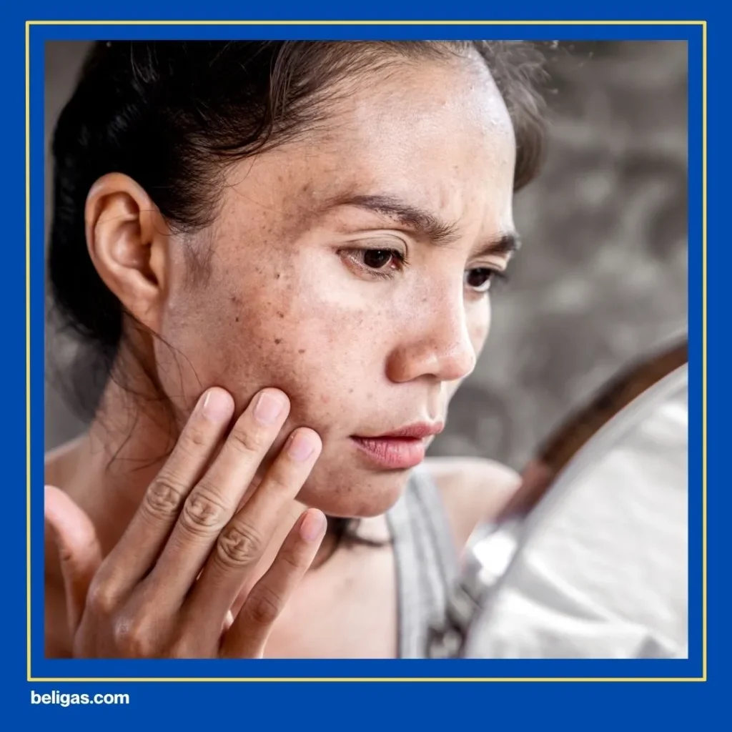 Efek Samping Steroid Pada Skincare