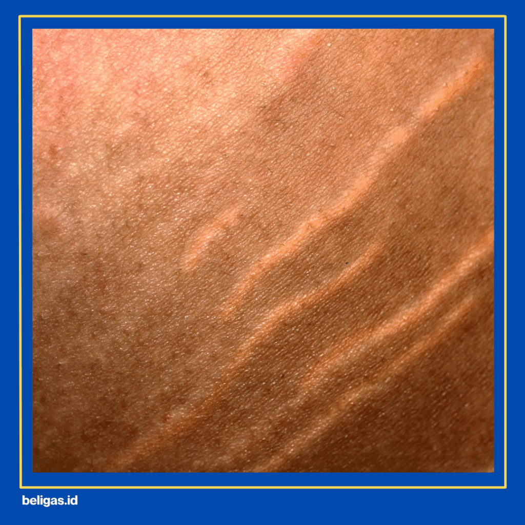 Cara Menghilangkan Stretch Mark Akibat Steroid