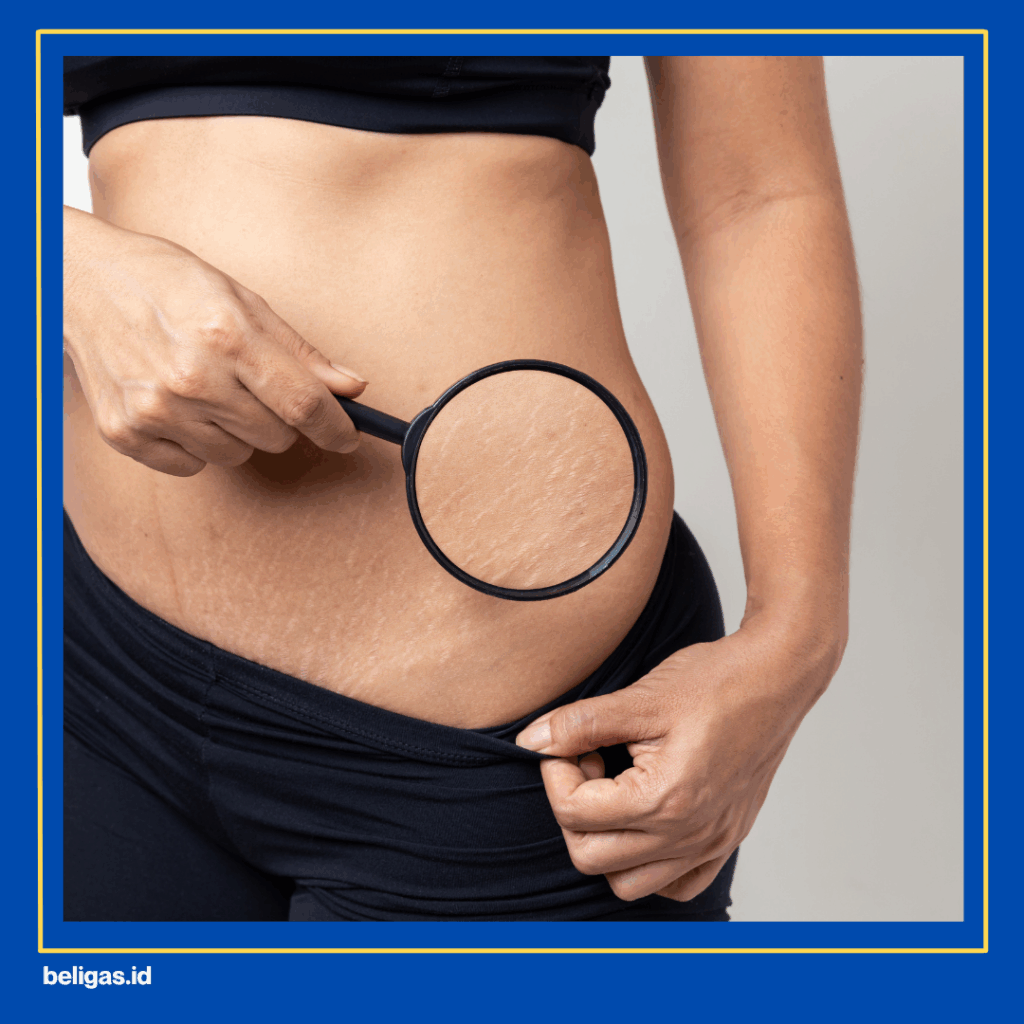 Cara Menghilangkan Stretch Mark Akibat Steroid